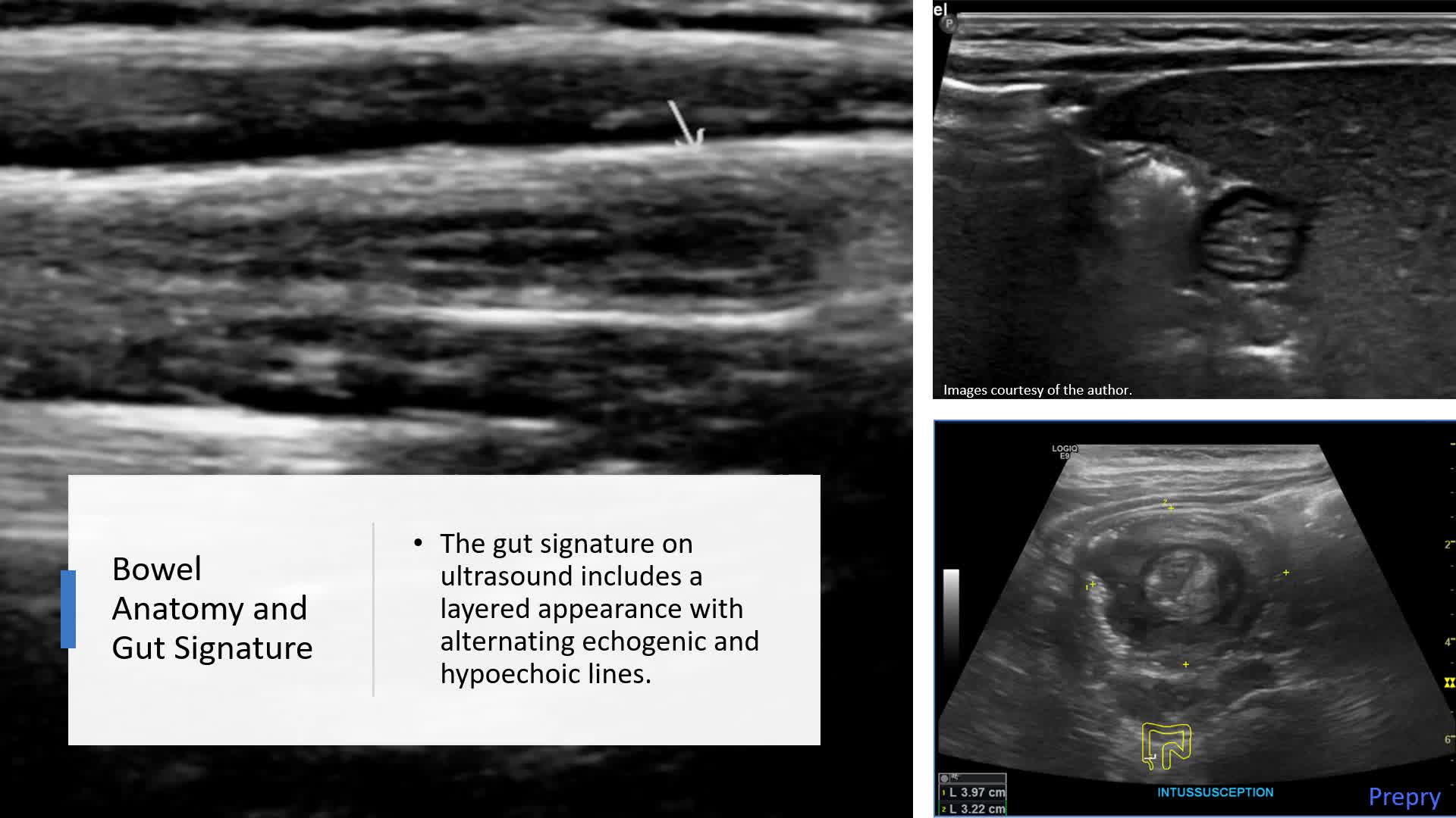 Biliary System and Pancreas - Part 2: Pancreas and Peritoneal